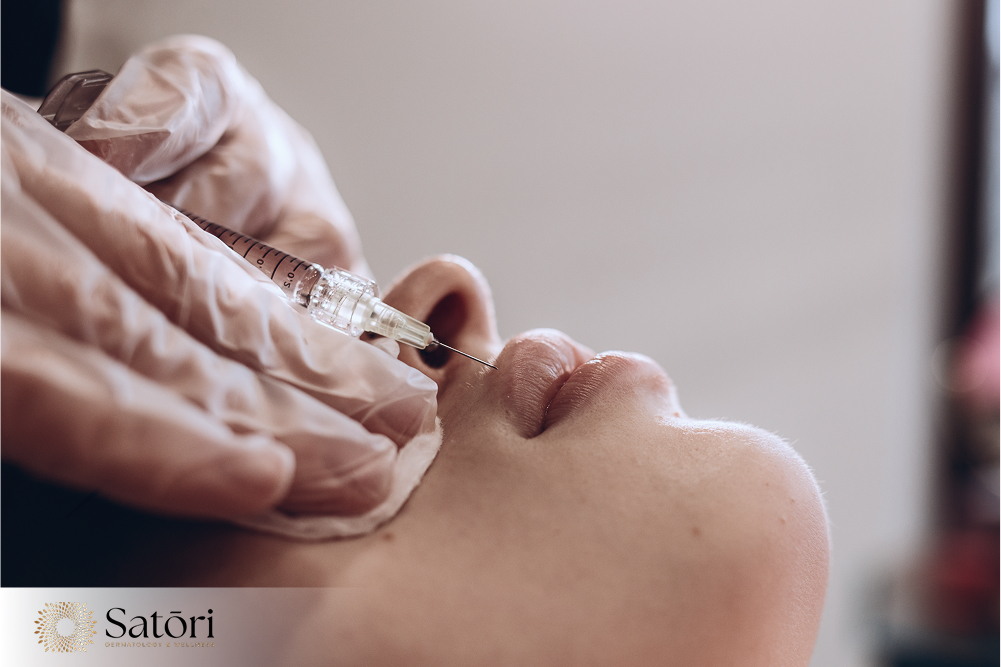 Close-up of lip filler injection procedure using dermal filler for lip enhancement