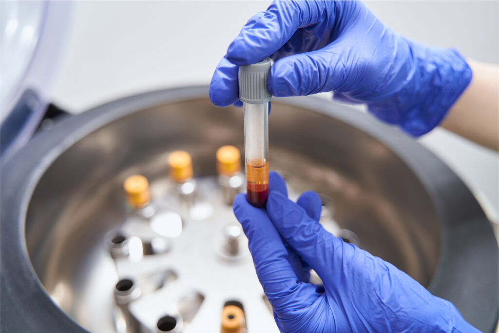 Gloved hands holding a blood vial for plasma PRP preparation.