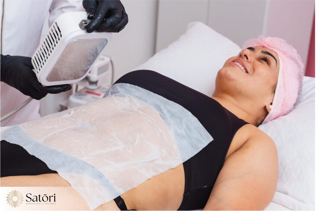 Woman lying on treatment bed in dermatology clinic prepared for CoolSculpting procedure