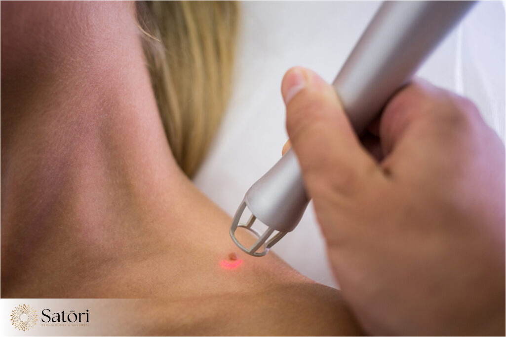Doctor's hand performing laser wart removal on woman's shoulder