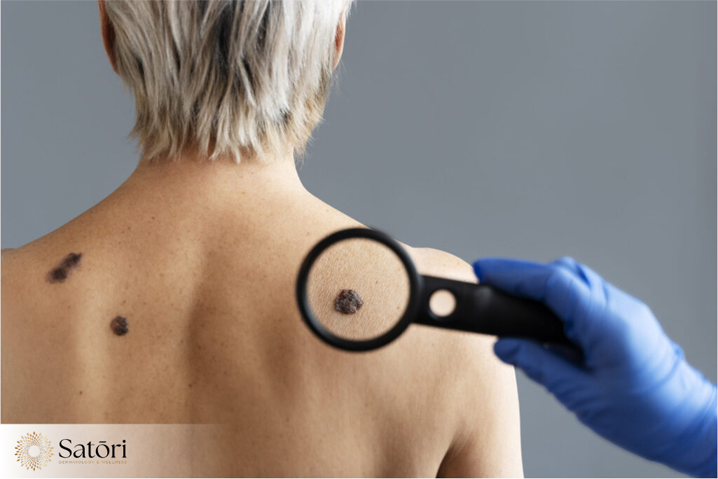 Doctor examining warts on woman's back with magnifying glass during dermatology treatment