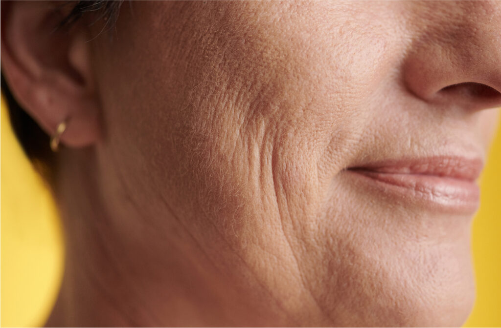 Close-up of an aged woman’s face highlighting smile line wrinkles
