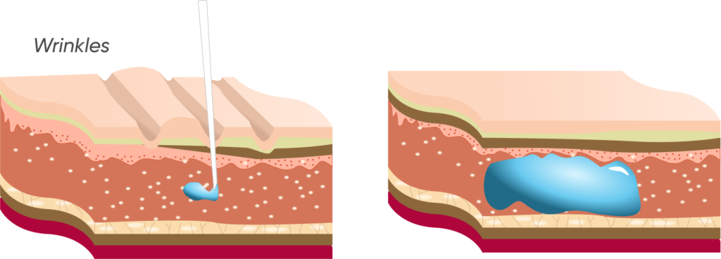 2D illustration showing the before and after effects of dermal filler treatment on facial features, highlighting volume restoration and smoother skin appearance.