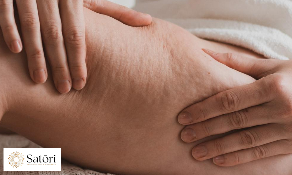 Close-up image of skin showing visible cellulite dimples and texture