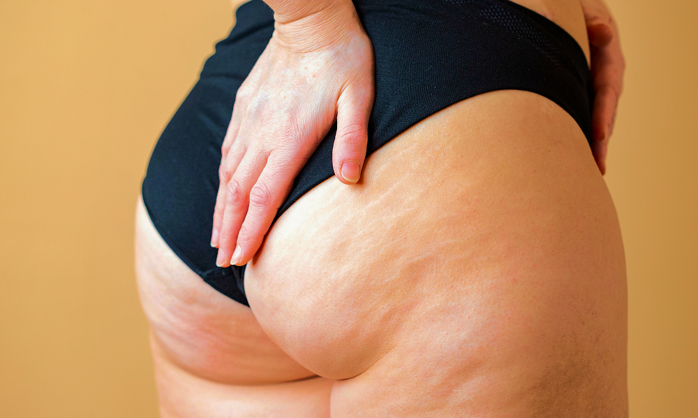Close-up image of skin showing visible cellulite dimples and texture.