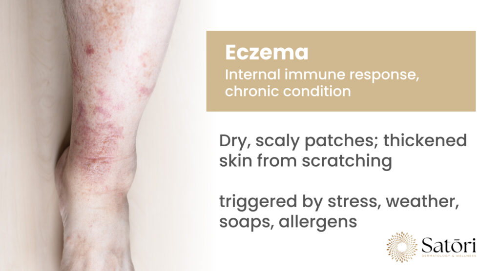 Eczema, internal immune response chronic condition.
