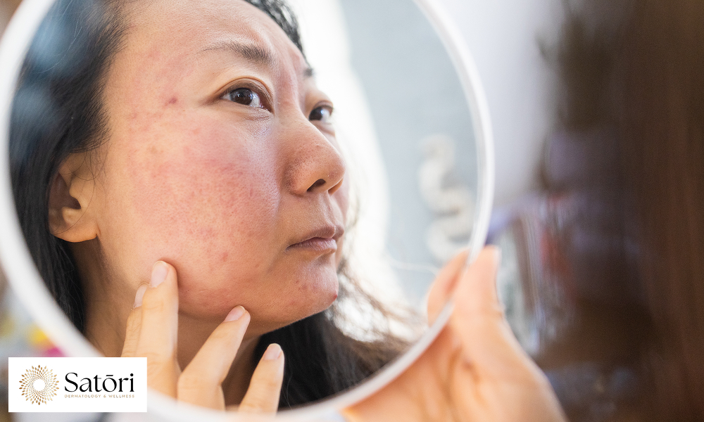 Dermatology, puberty Asian young woman, girl looking into mirror, allergy presenting an allergic rea