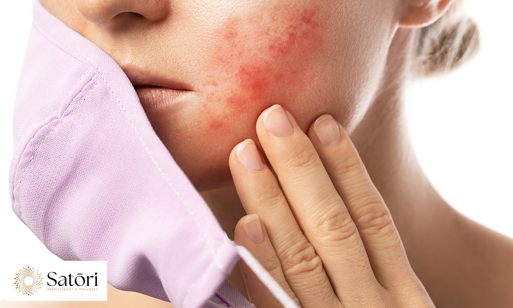 acne breakouts from wearing a face mask