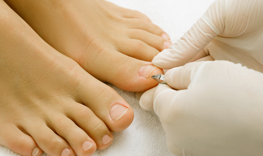 Female dermatologist wearing gloves cutting ingrown toenail during treatment