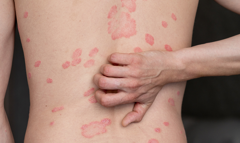Eczema skin patches are typically red, itchy, and scaly