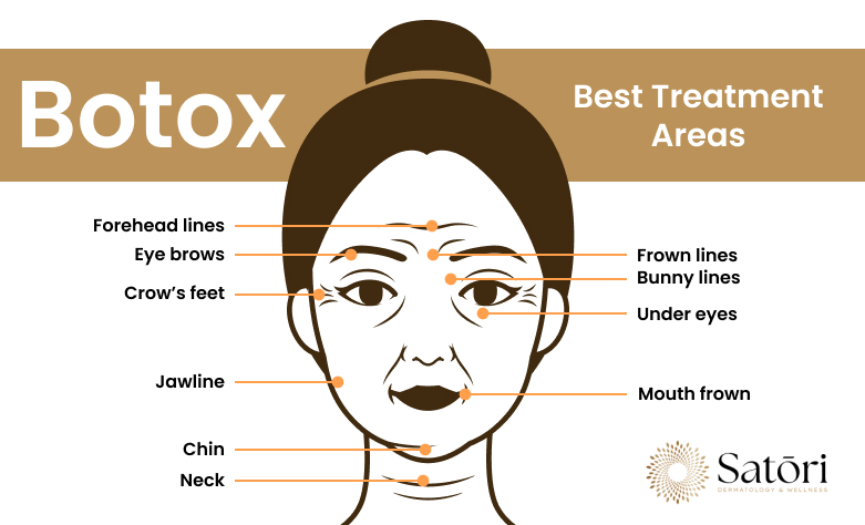 Botox best treatment areas.
