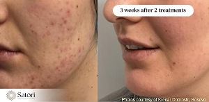 Tixel acne results before after Franklin TN