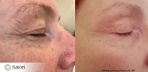 Tixel eye results before after Franklin TN