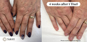 Tixel hand results before after Franklin TN