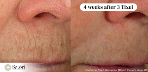 Tixel lip lines results before after Franklin TN