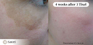 Tixel pigment results before after Franklin TN